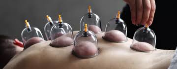 Cupping Therapy